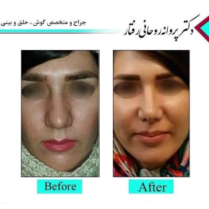 Rhinoplasty-1