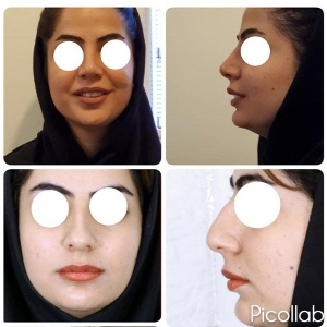 Rhinoplasty-10