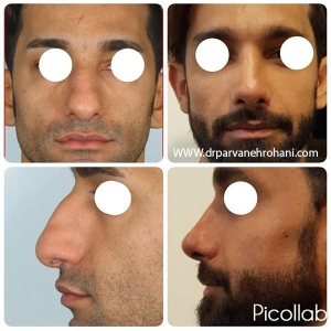 Rhinoplasty-12