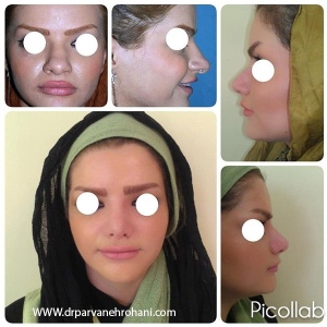 Rhinoplasty-13