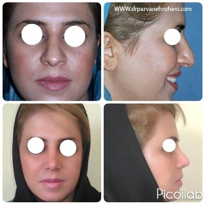 Rhinoplasty-14