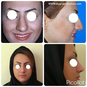 Rhinoplasty-15
