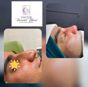 Rhinoplasty-16