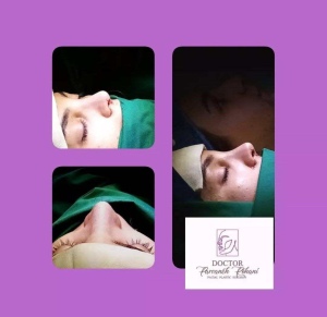 Rhinoplasty-18