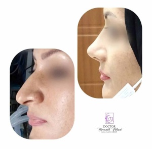 Rhinoplasty-19