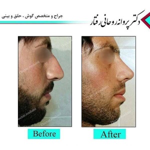 Rhinoplasty-2