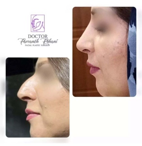 Rhinoplasty-20