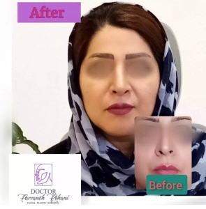 Rhinoplasty-21
