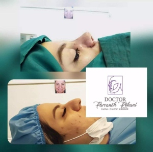 Rhinoplasty-22