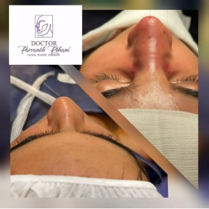 Rhinoplasty-23