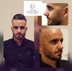 Rhinoplasty-24