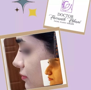 Rhinoplasty-26