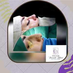 Rhinoplasty-27