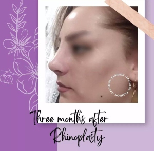 Rhinoplasty-28