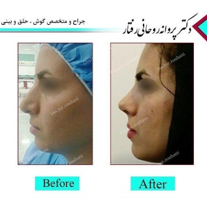 Rhinoplasty-3