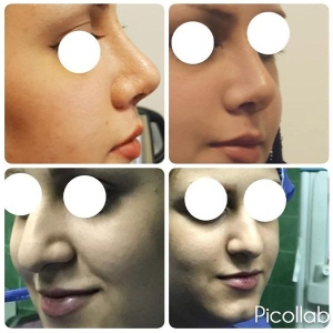 Rhinoplasty-4