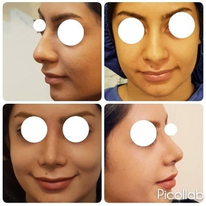 Rhinoplasty-5