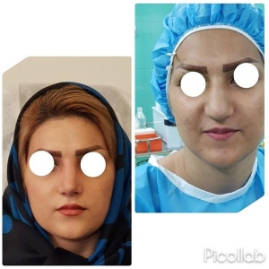 Rhinoplasty-6