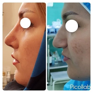Rhinoplasty-7
