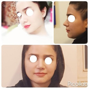 Rhinoplasty-8