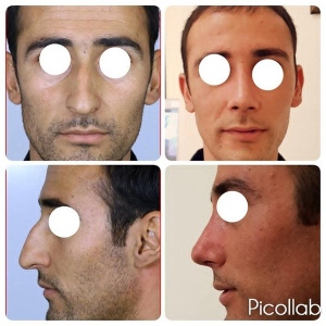 Rhinoplasty-9